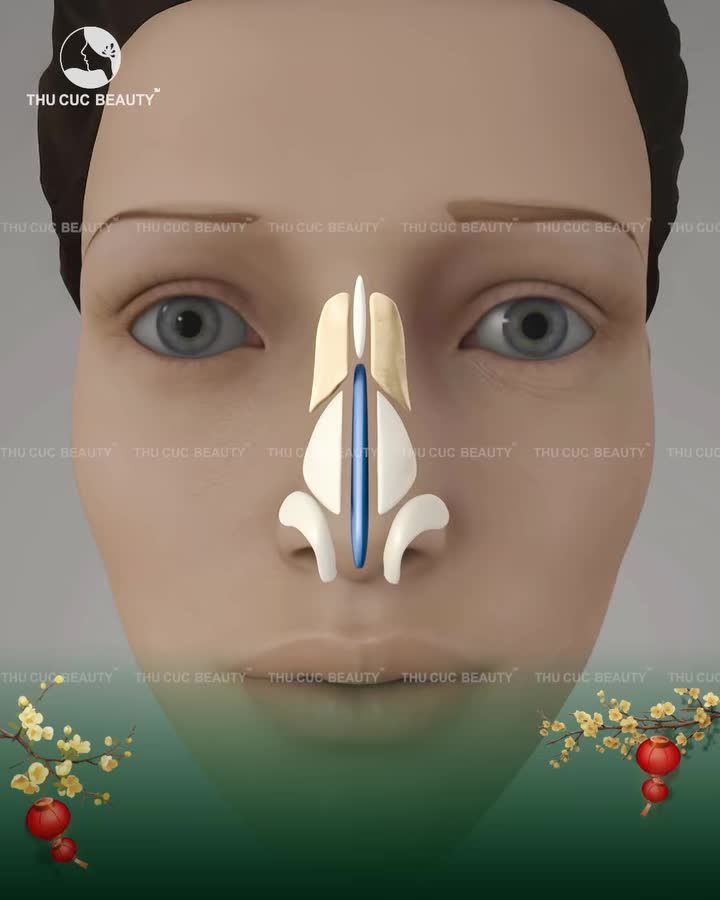 Nâng mũi cấu trúc - Tái tạo dáng mũi toàn diện