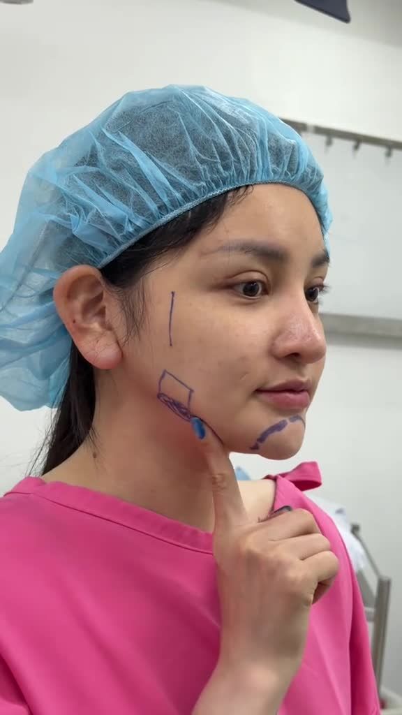 KHẮC PHỤC HÀM LỒI LÕM KHÔNG ĐỀU NHỜ CÔNG NGHỆ FACE SCAN 3D TẠI SAIGON VENUS