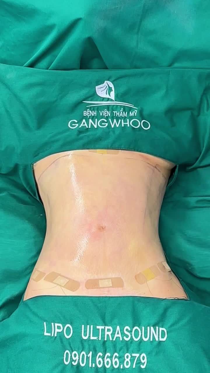 CẬN CẢNH KẾT QUẢ HÚT MỠ BỤNG SAU 60 PHÚT TẠI GANGWHOO