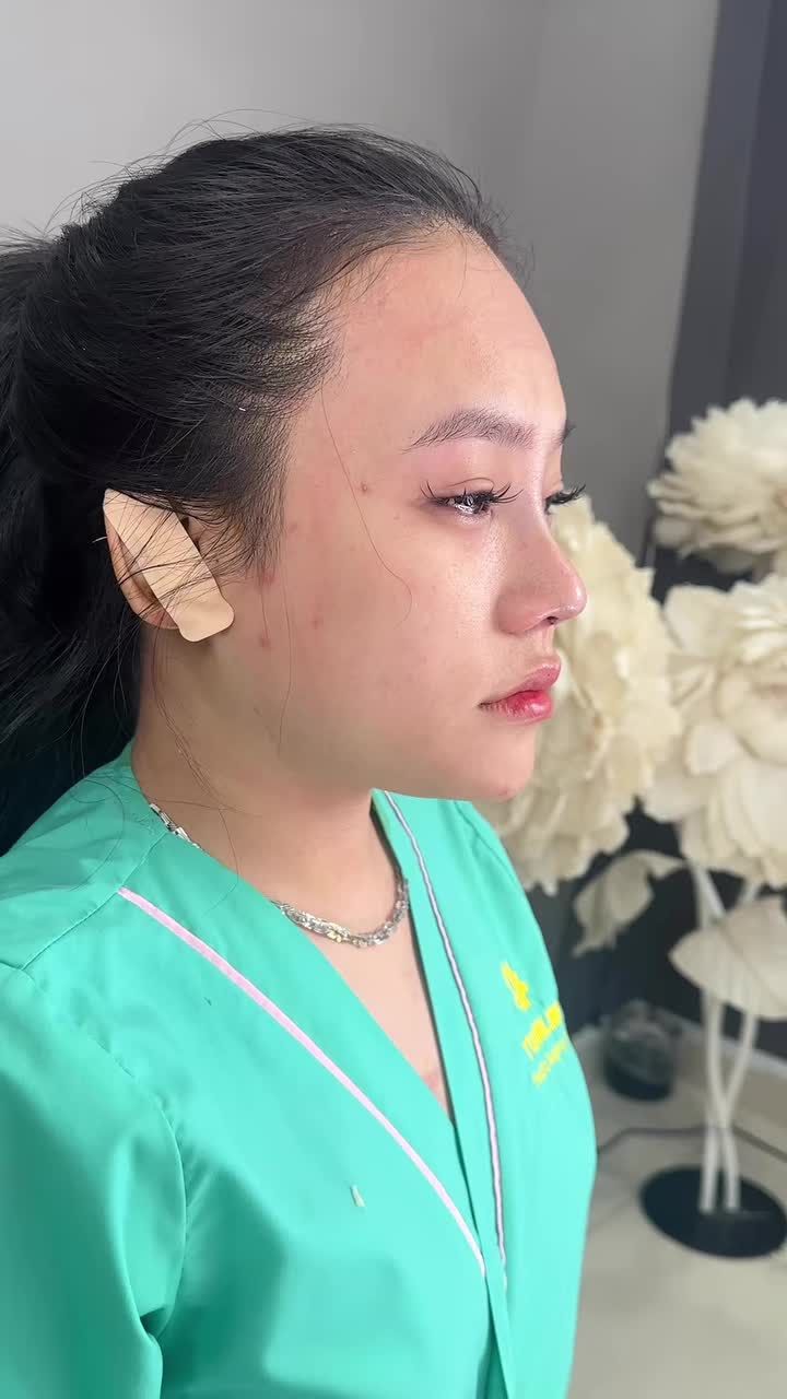 NÂNG MŨI CẤU TRÚC VỪA HOÀN THÀNH CHO BÉ KHÁCH ĐẾN TỪ QUẢNG NAM!!
