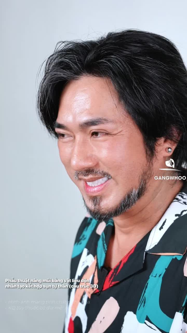 Hài lòng với combo sửa mũi lại + cắt mí sau 3 năm thực hiện