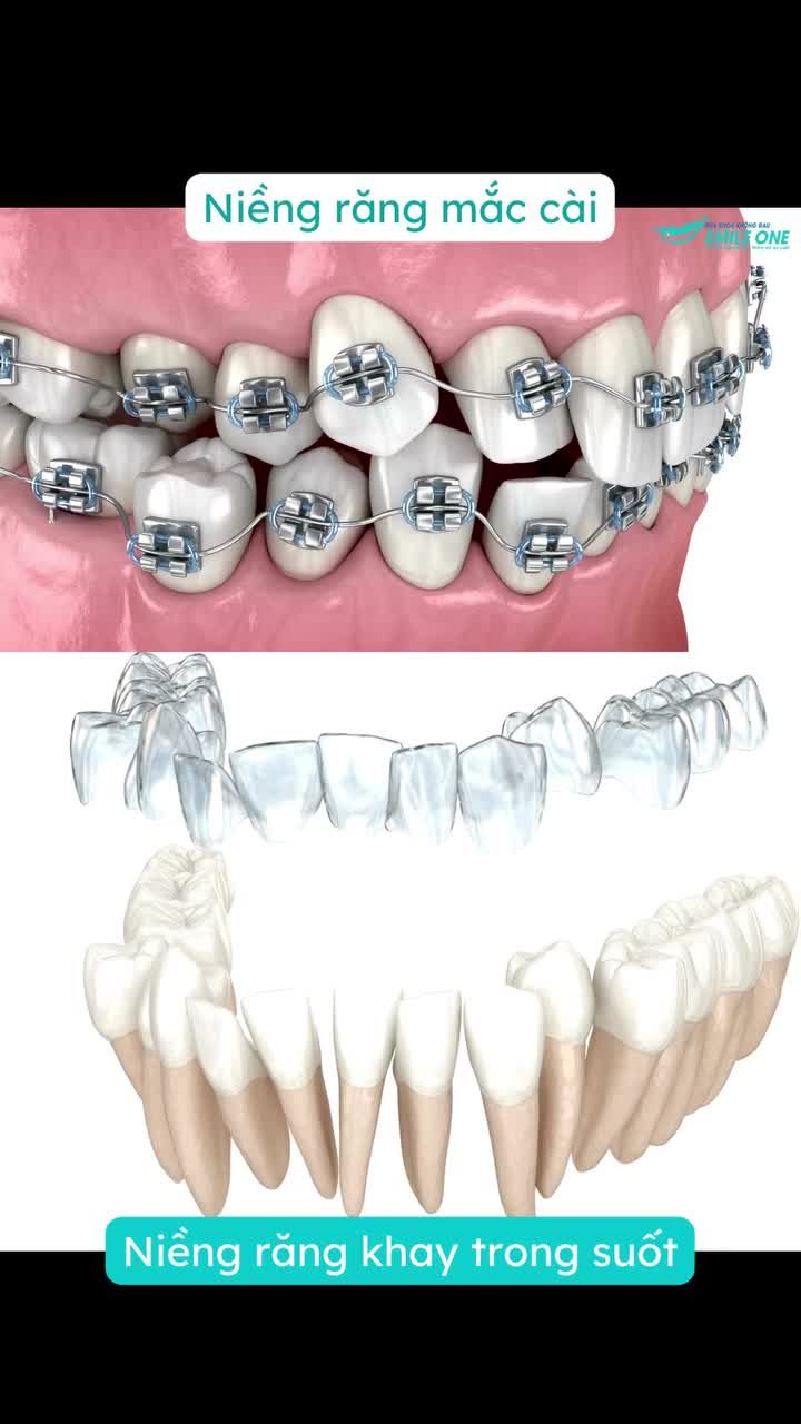 Niềng răng mắc cài và Invisalign: Khác nhau như thế nào?
