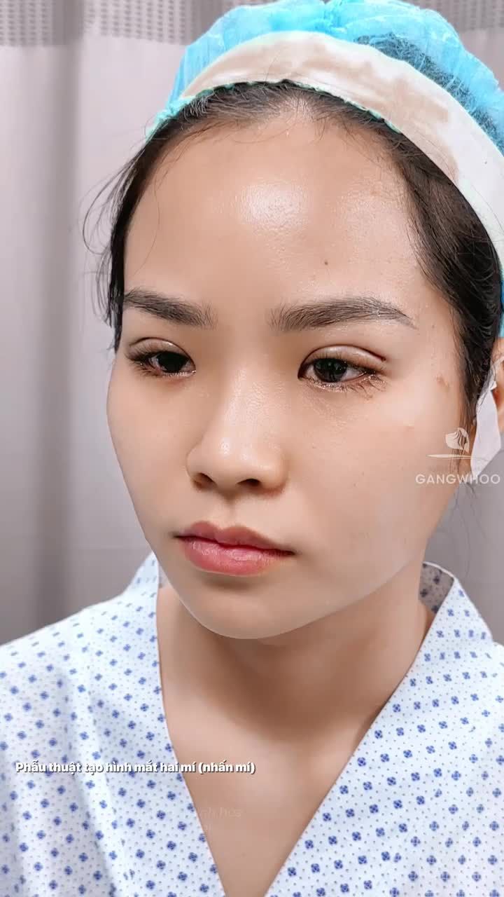 Sở hữu đôi mắt hai mí to tròn vớSở hữu đôi mắt hai mí to tròn với giải pháp bấm mí dành cho những bạn trẻ yêu thích sự tự nhiên. i giải pháp bấm mí dành cho những bạn trẻ yêu thích sự tự nhiên.