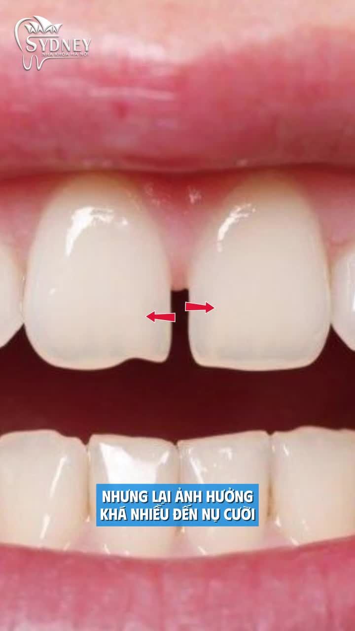 Trám răng cửa thưa - Cải thiện thẩm mỹ