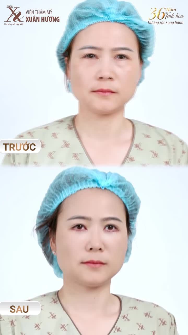 TRẺ HÓA ĐÔI MẮT VỚI PHƯƠNG PHÁP CẮT MÍ DƯỚI GIẤU CHỈ