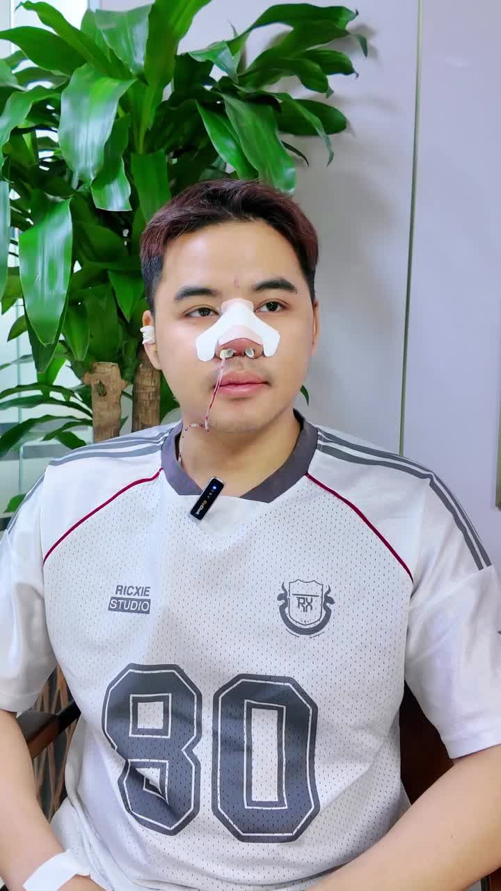 TÂM SỰ CÙNG ANH NHÂN VIÊN VĂN PHÒNG: NÂNG MŨI CẤU TRÚC SURGIFORM CÓ "NHẸ NHÀNG" NHƯ LỜI ĐỒN?