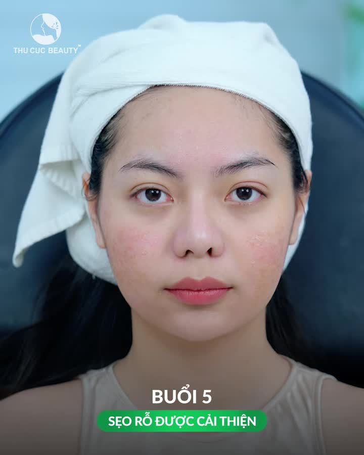 Hiệu quả "lột xác"- da mịn màng, hết sẹo tới 90%