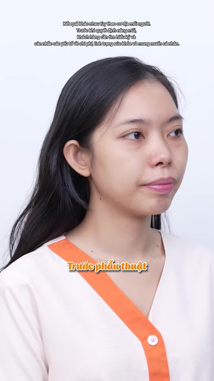 Khắc phục khuyết điểm hàm hô nhờ nâng mũi?