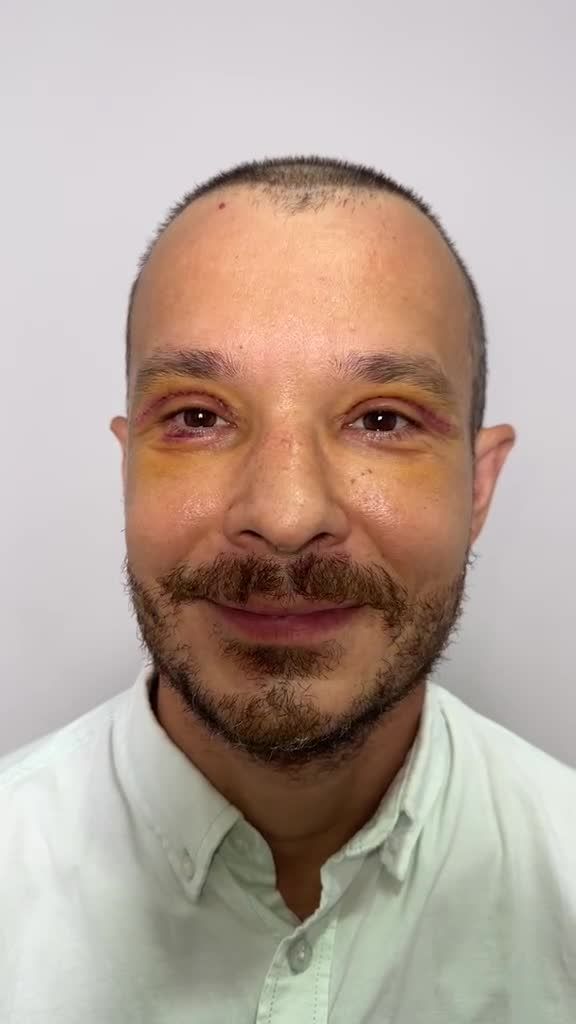 CẬN CẢNH: Nhan sắc cực điển trai của nam khách hàng U50 người Nga sau Combo Trẻ hóa mắt tại JW