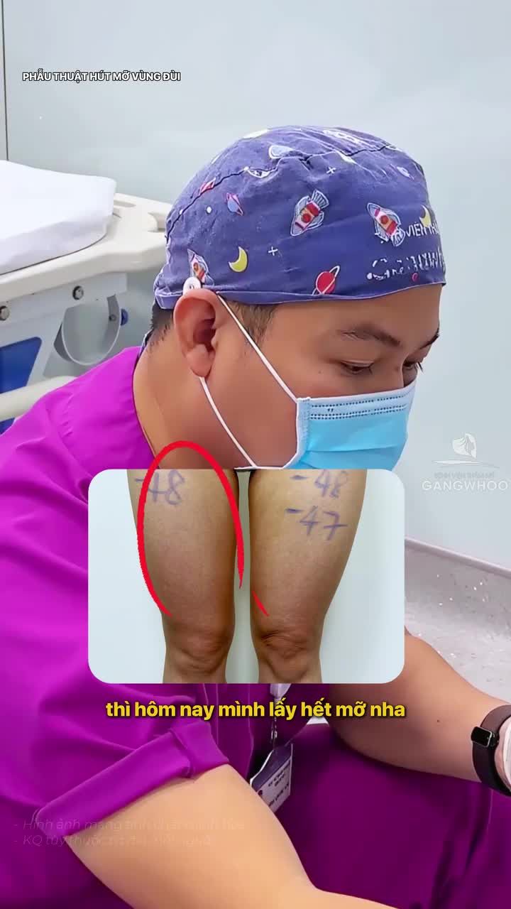 Khắc phục đùi kém thon an toàn, nhẹ nhàng sau 30 phút phẫu thuật hút mỡ vùng đùi tại Gangwhoo