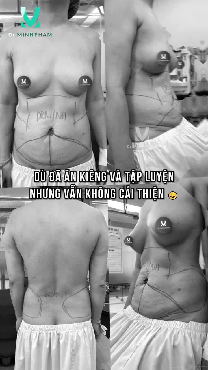 BỤNG MỠ KHÓ GIẢM – GIẢI PHÁP HÚT MỠ HIỆU QUẢ