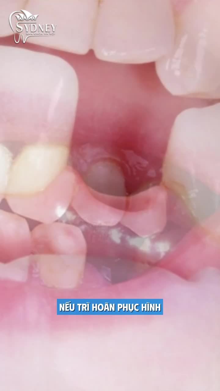 5 LÝ DO BẠN NÊN TRỒNG RĂNG NGAY KHI MẤT RẮNG