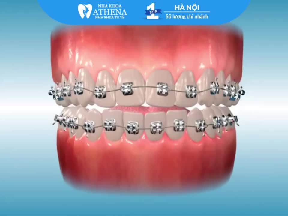 Nong hàm trong quá trình niềng răng là gì?