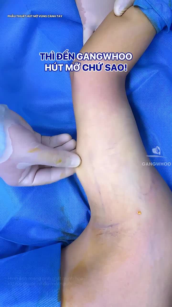 Ngại bắp tay to thì phải đến Gangwhoo chốt liền dịch vụ giảm mỡ cánh tay ngay thôi nào