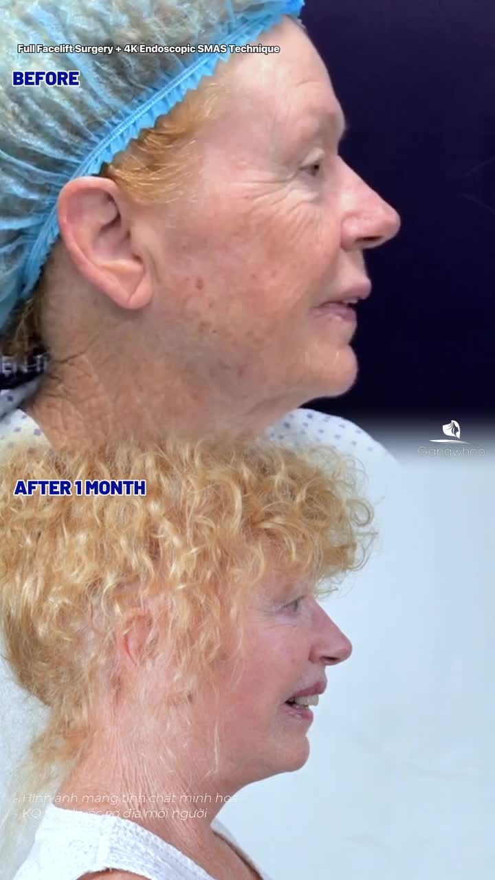 Nhan sắc 69 tuổi trước và sau phẫu thuật căng da mặt toàn phần + Smas nội soi 4K của khách hàng New Zealand