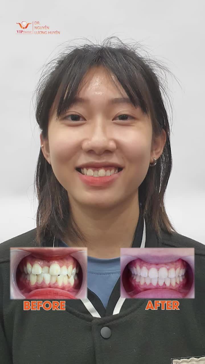 Khách hàng nâng cấp nụ cười cấp tốc với phác đồ Niềng Răng Không Nhổ Răng tại VIP Dentist !
