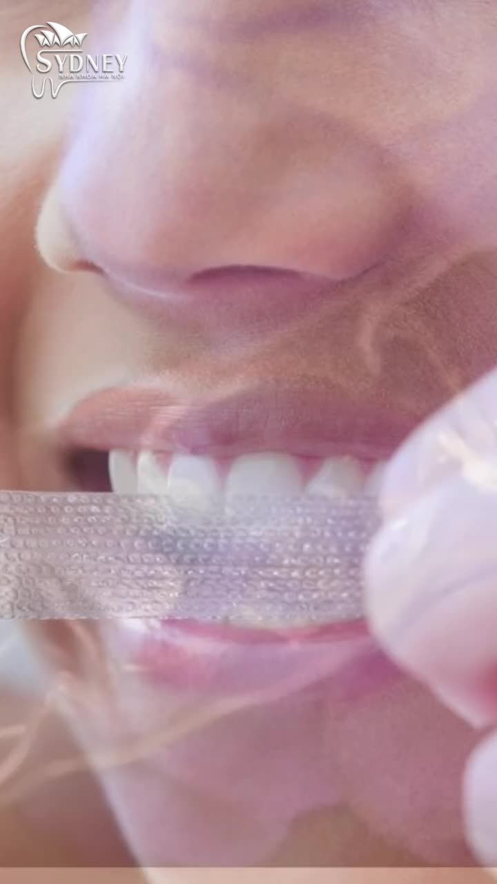 Sự thật về việc tẩy trắng răng tại nhà