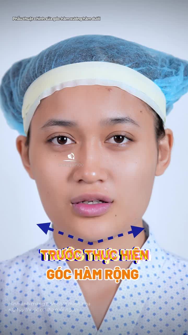 Chỉ sau 3 tháng, góc hàm thon gọn. Tự tin khoe các góc nghiêng và theo đuổi các phong cách mà bạn muốn.