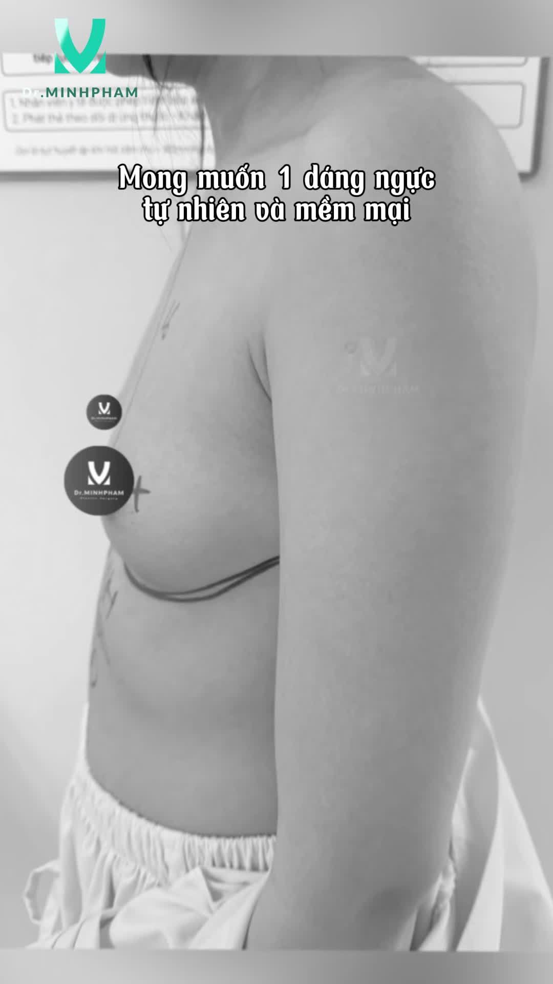 Ngực lép V1 căng tròn với dòng túi Nagor SVN size 270cc