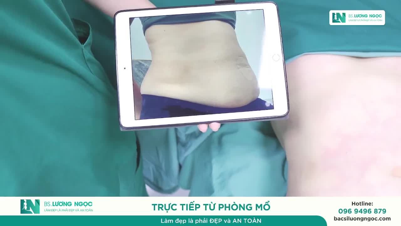 KHÁCH HÀNG SAU NHIỀU LẦN SINH – LỘT XÁC VÒNG EO, HOÀN THIỆN VÒNG 1