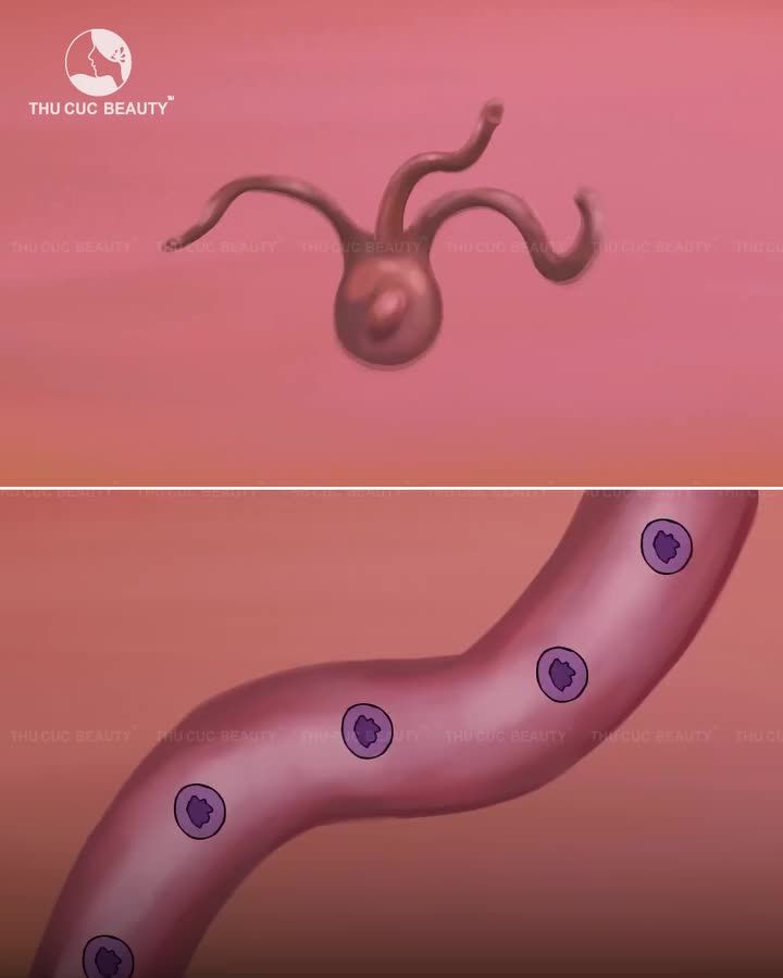 LÀM THẾ NÀO ĐỂ TRỊ ĐƯỢC CHÂN NÁM?