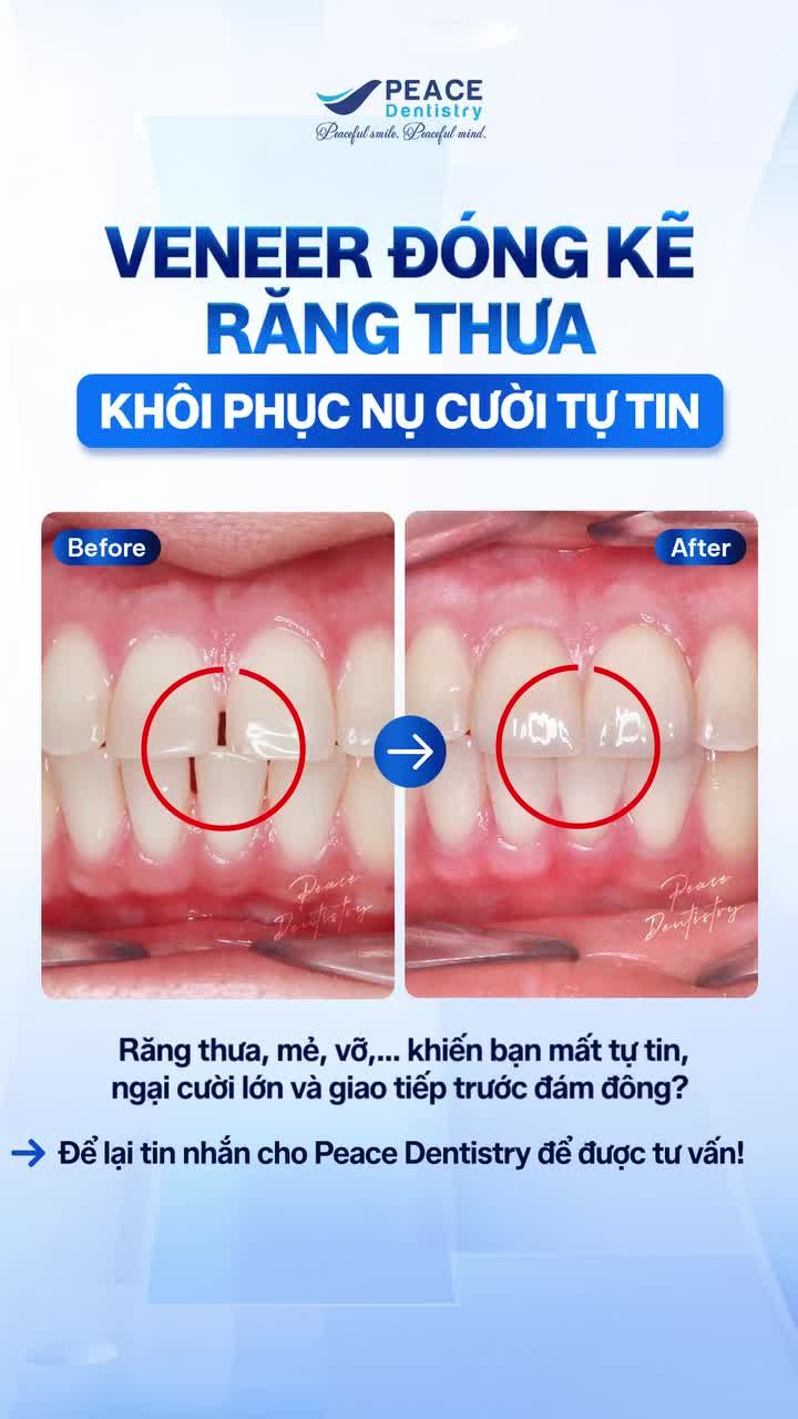 Xem thêm 8 video Mặt Dán Sứ Veneer của bác sĩ Bs nha khoa Peace Dentistry