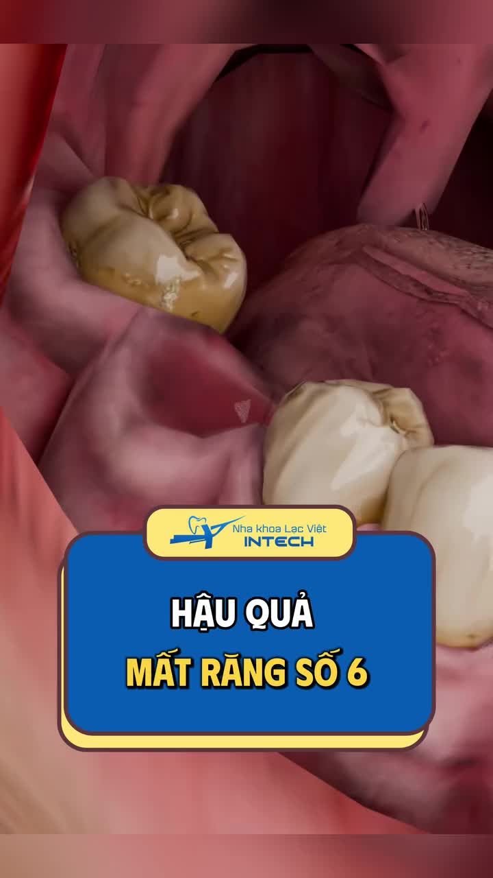 H/ậu quả m/ất răng số 6