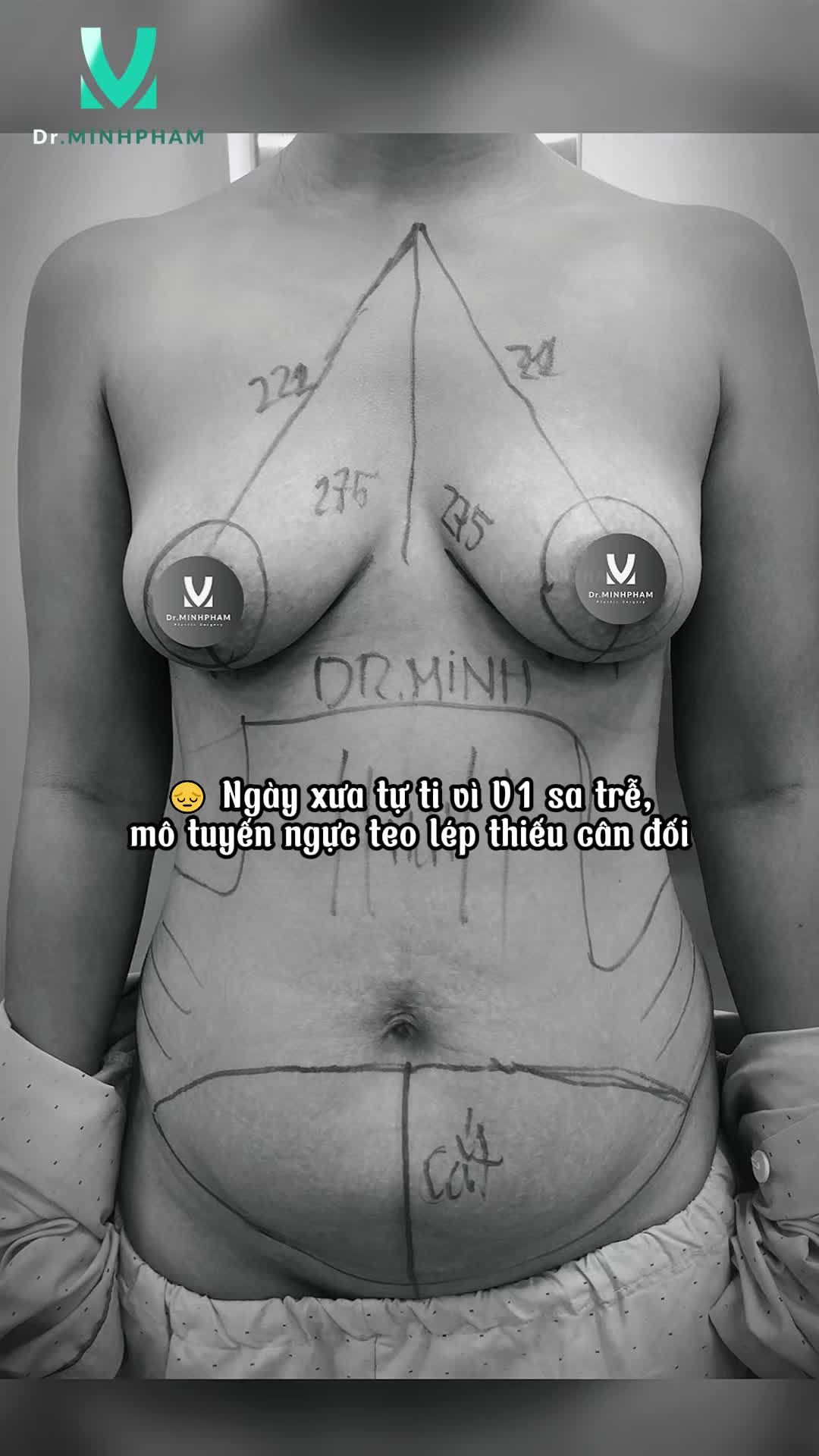 Quyết tâm " đại trùng tu" body để lấy lại sắc vóc sau sinh của khách hàng tại Dr. Minh Phạm