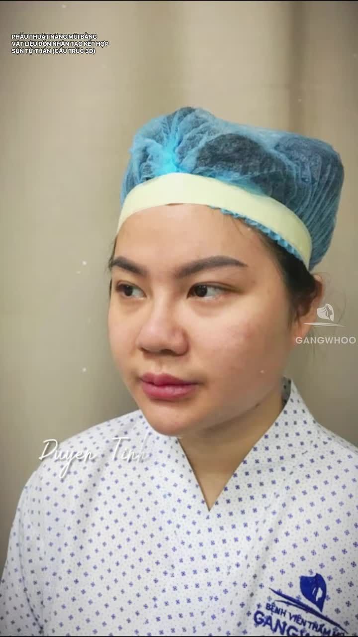 Nâng mũi Thay đầu