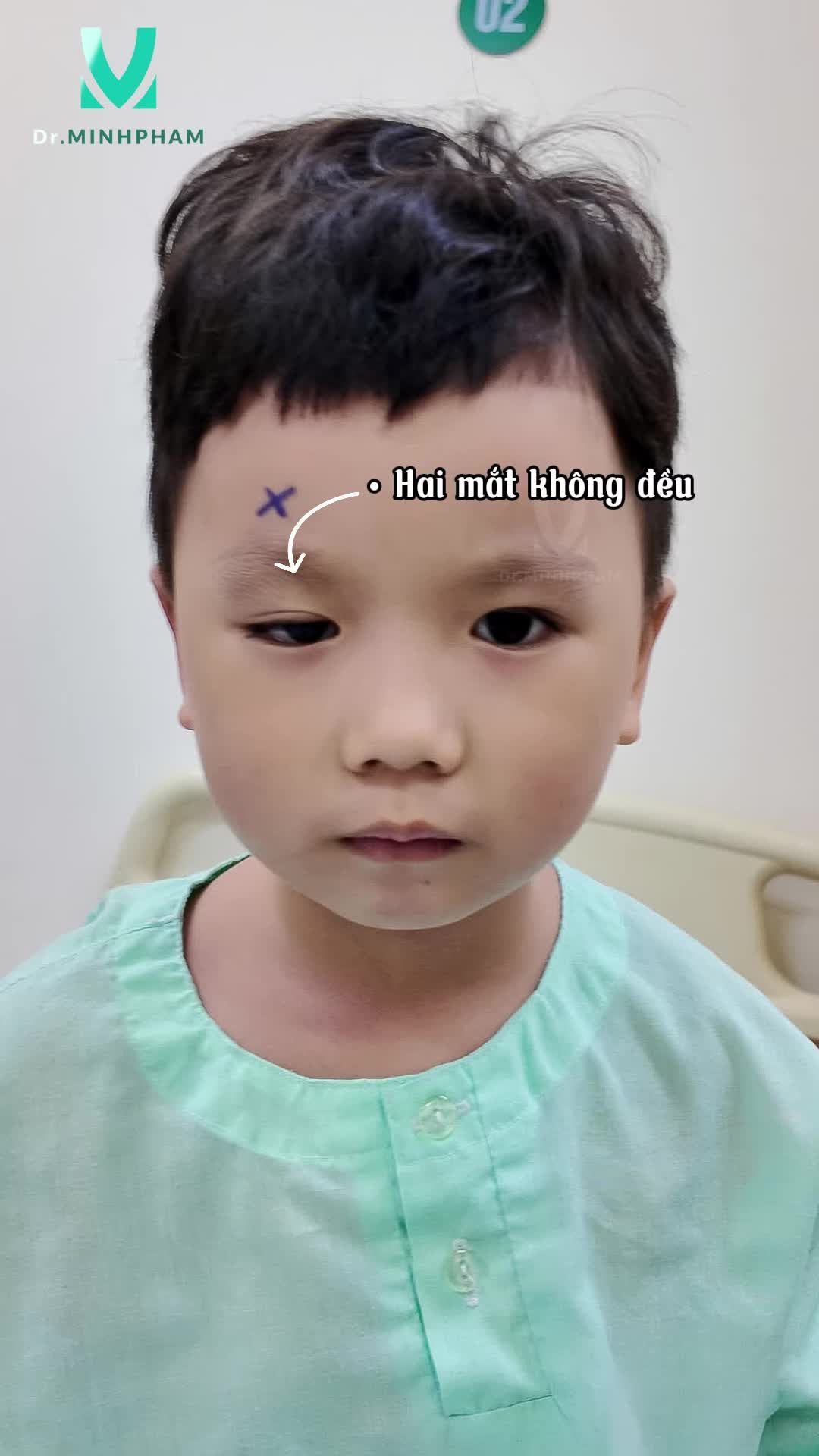 Tình trạng trước điều trị: Mí mắt sụp, che một phần đồng tử  Hai mắt không đều, ánh nhìn kém tươi tắn