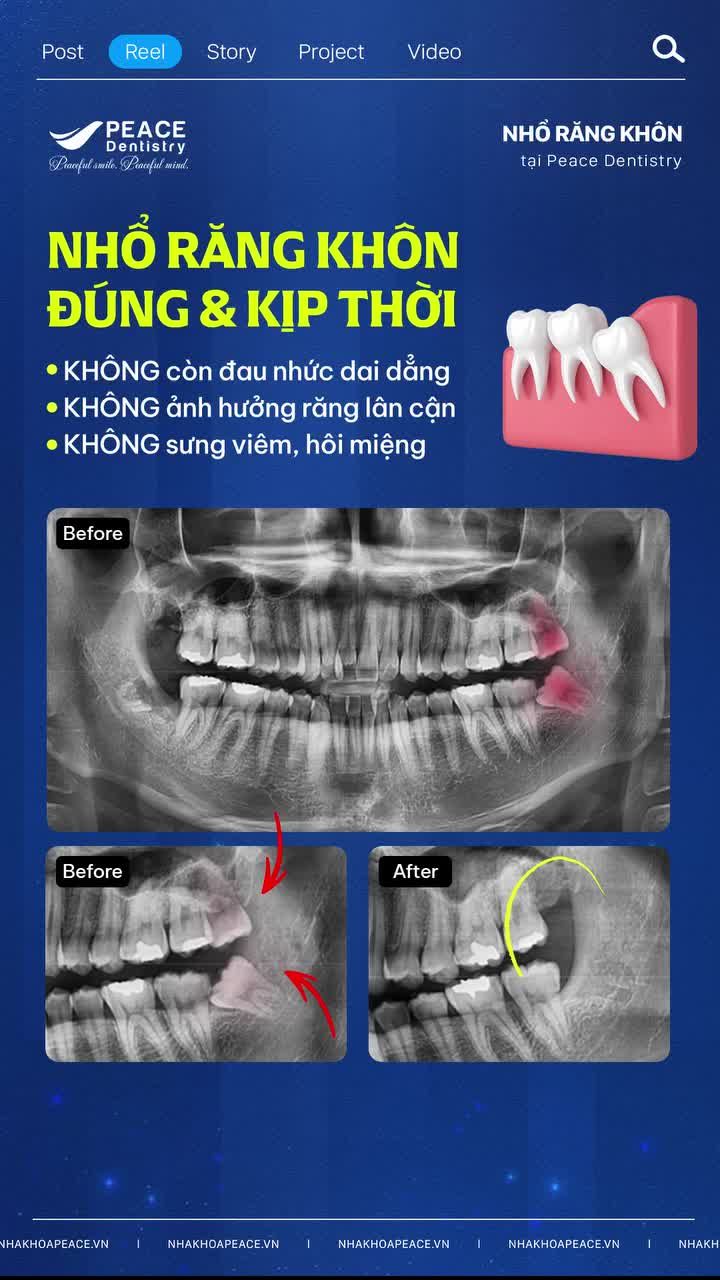 Răng khôn thường không có biểu hiện rõ ràng ngay từ đầu.