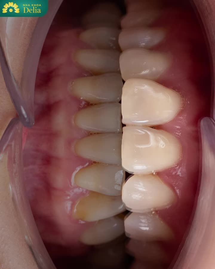 NÂNG CẤP NỤ CƯỜI ĐỂ TỰ TIN LÀ CHÍNH MÌNH