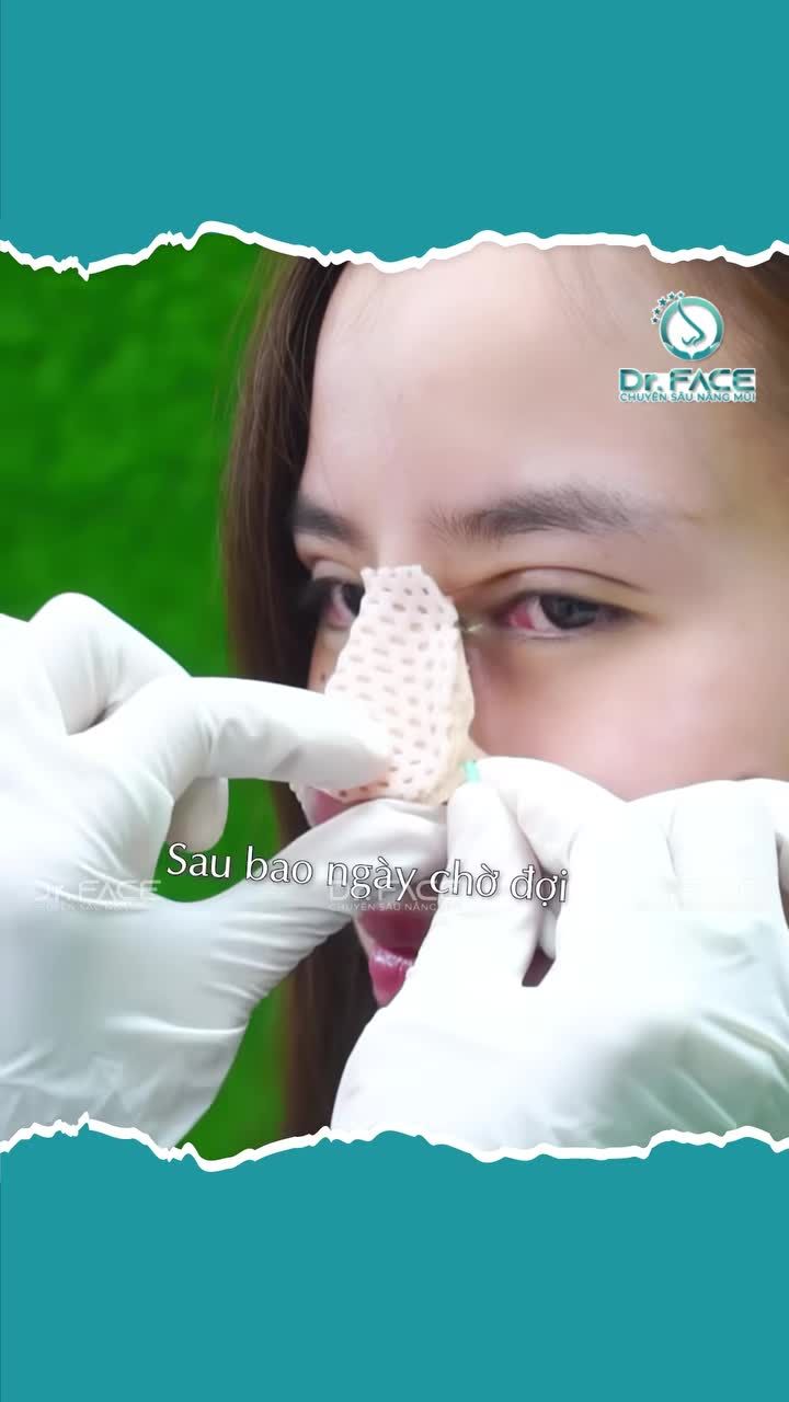 TÒ MÒ SAU 7 NGÀY NÂNG MŨI THAY ĐỔI CẢ GƯƠNG MẶT