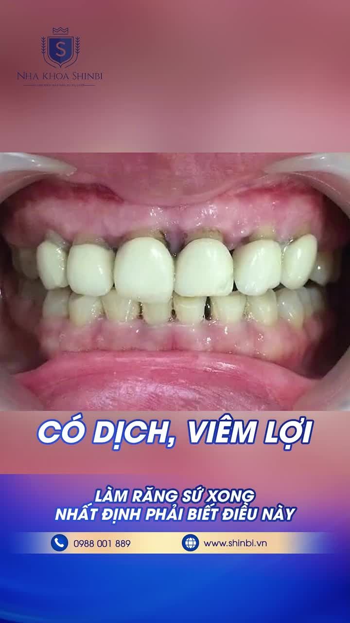 LÀM RĂNG SỨ XONG NHẤT ĐỊNH PHẢI BIẾT ĐIỀU NÀY!