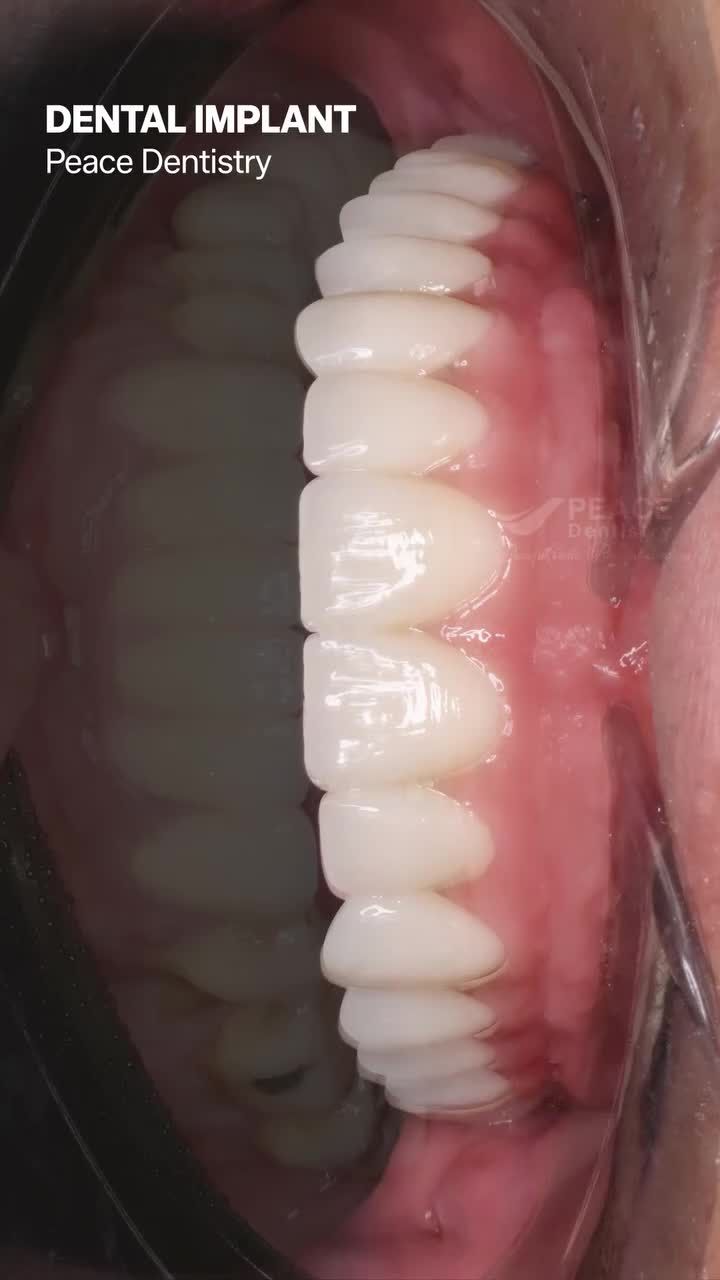 Khách hàng của Peace Dentistry luôn chia sẻ rằng ước gì mình “làm răng sớm hơn”.