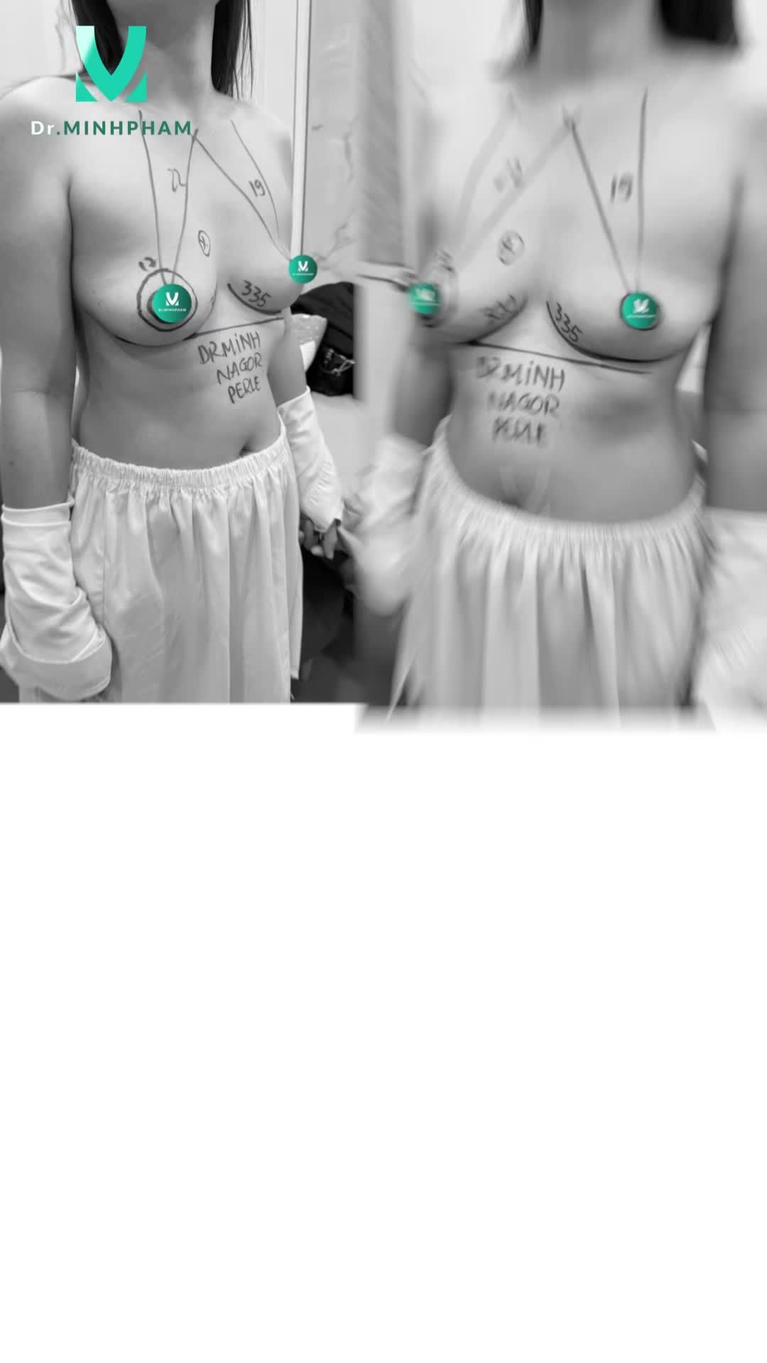 Từ tự ti vòng 1 teo lép ➝ V1  căng tròn tự tin với mọi outfit