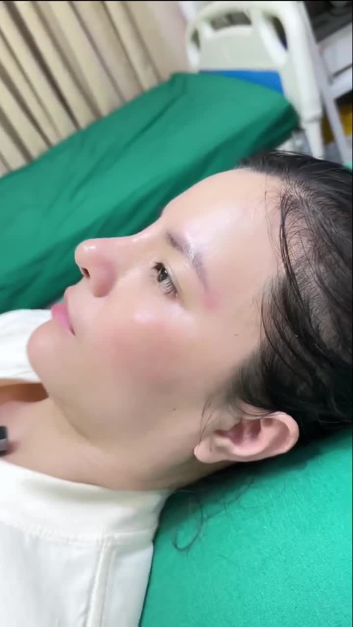 KẾT QUẢ NÂNG MŨI SỤN SƯỜN NGAY SAU KHI THÁO NẸP + CẮT CHỈ!!