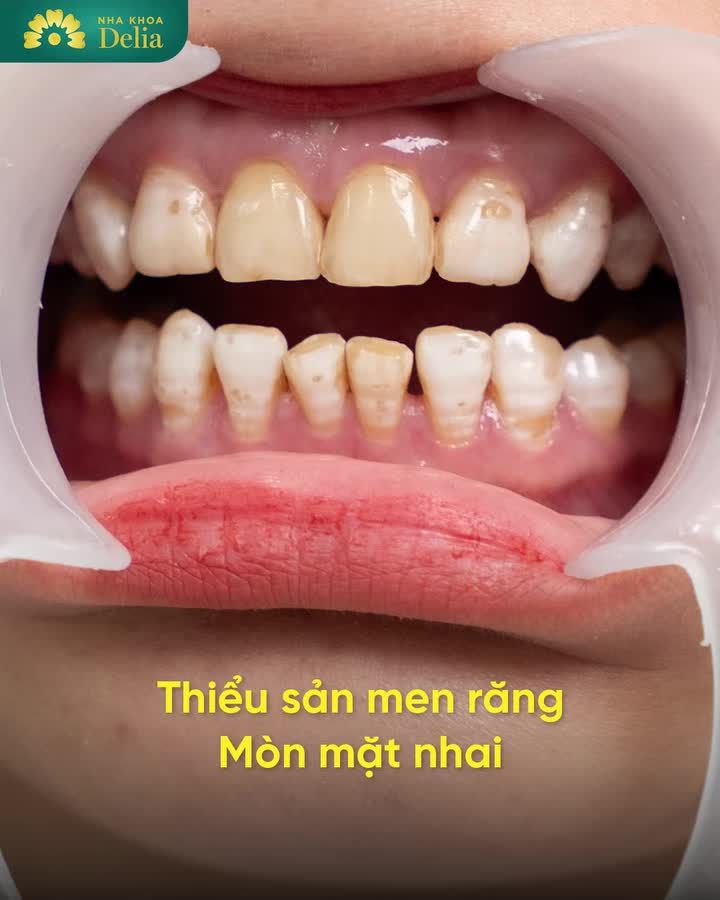 Răng ố vàng, thiểu sản men răng đến Delia bọc răng sứ về ai cũng bảo quyết định đúng. Xem ngay