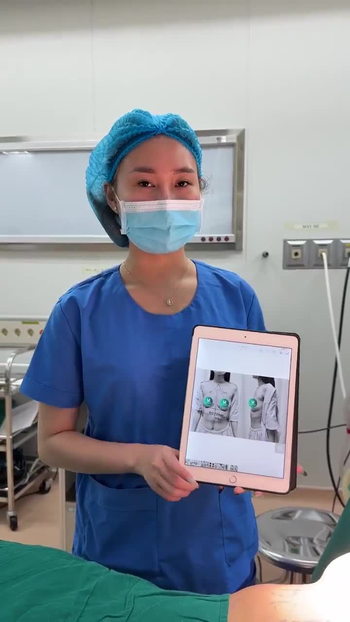 Nâng ngực Xtra 295cc (P) 270cc (T)