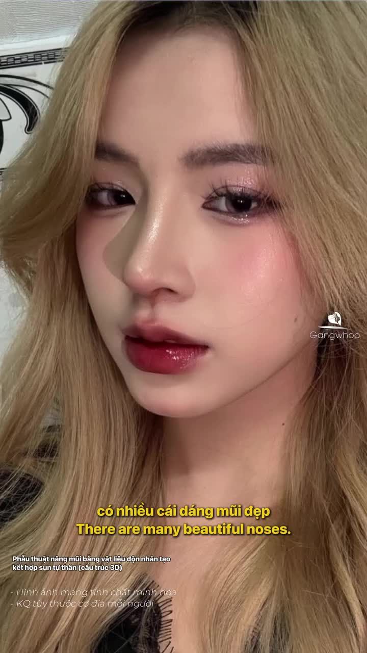 Ca lột xác sau nâng mũi khiến ai cũng trầm trồ