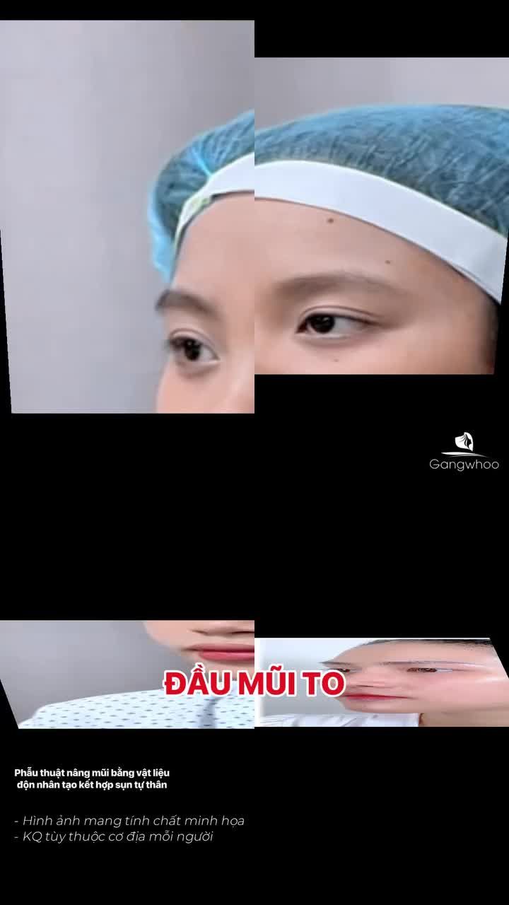 Top những màn lột xác sau nâng mũi tại BVTM Gangwhoo