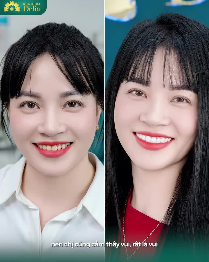 Nếu cả đời không rực rỡ thì sao? Thì đi Làm răng sứ để cười cho rạng rỡ hơn