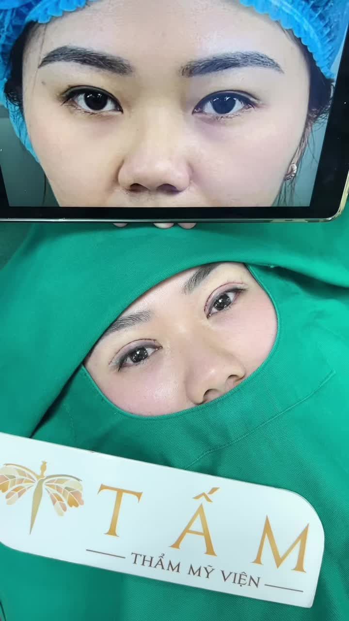 "Biến hình" mí mắt sụp, thiếu cân đối trở thành hai mí sắc nét chỉ trong 30 phút.