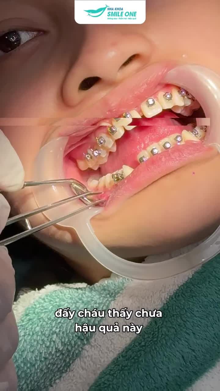 NIỀNG RĂNG 4 NĂM… NHƯNG KHỚP CẮN CÒN LỆCH HƠN BAN ĐẦU?