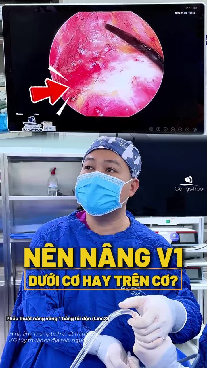 Nên nâng vòng 1 dưới cơ hay trên cơ? Cùng bác sĩ nhà Gangwhoo tìm hiểu xem đâu là phương pháp phù hợp nhất nhé