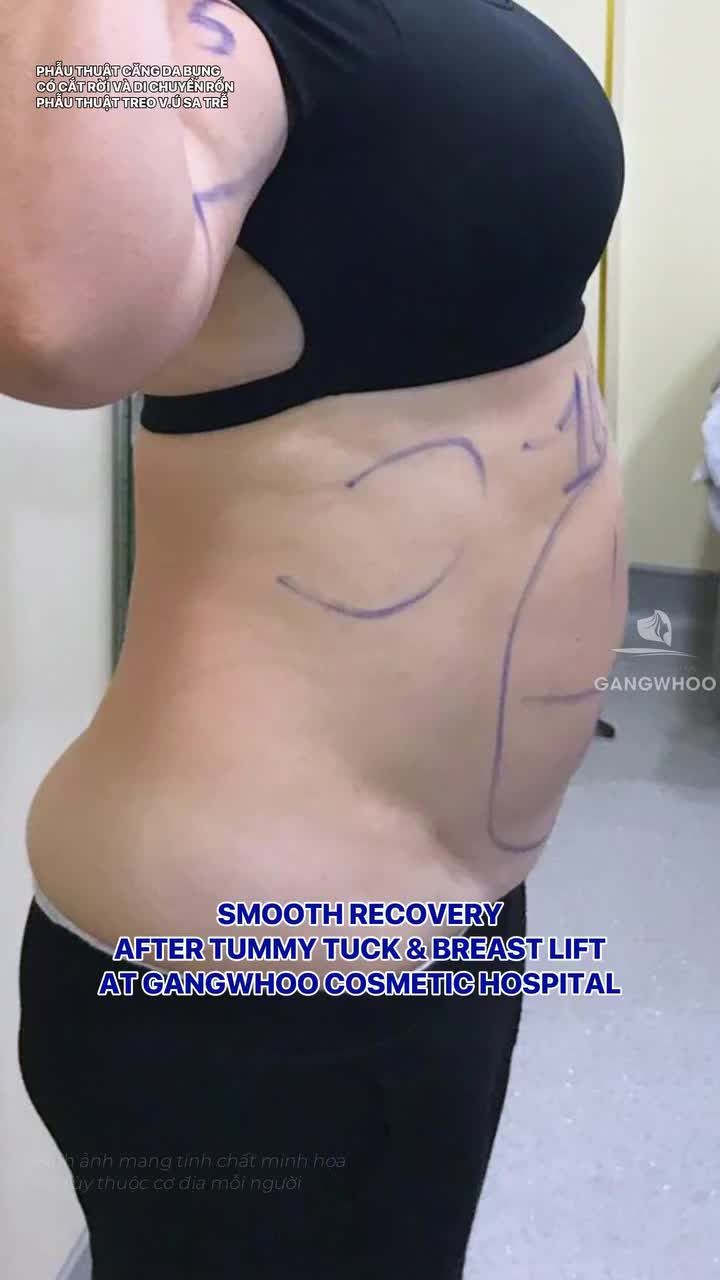 Phục hồi hậu phẫu êm ái của khách hàng vừa trải bụng vừa nâng ngực tại Bệnh viện Thẩm mỹ Gangwhoo.
