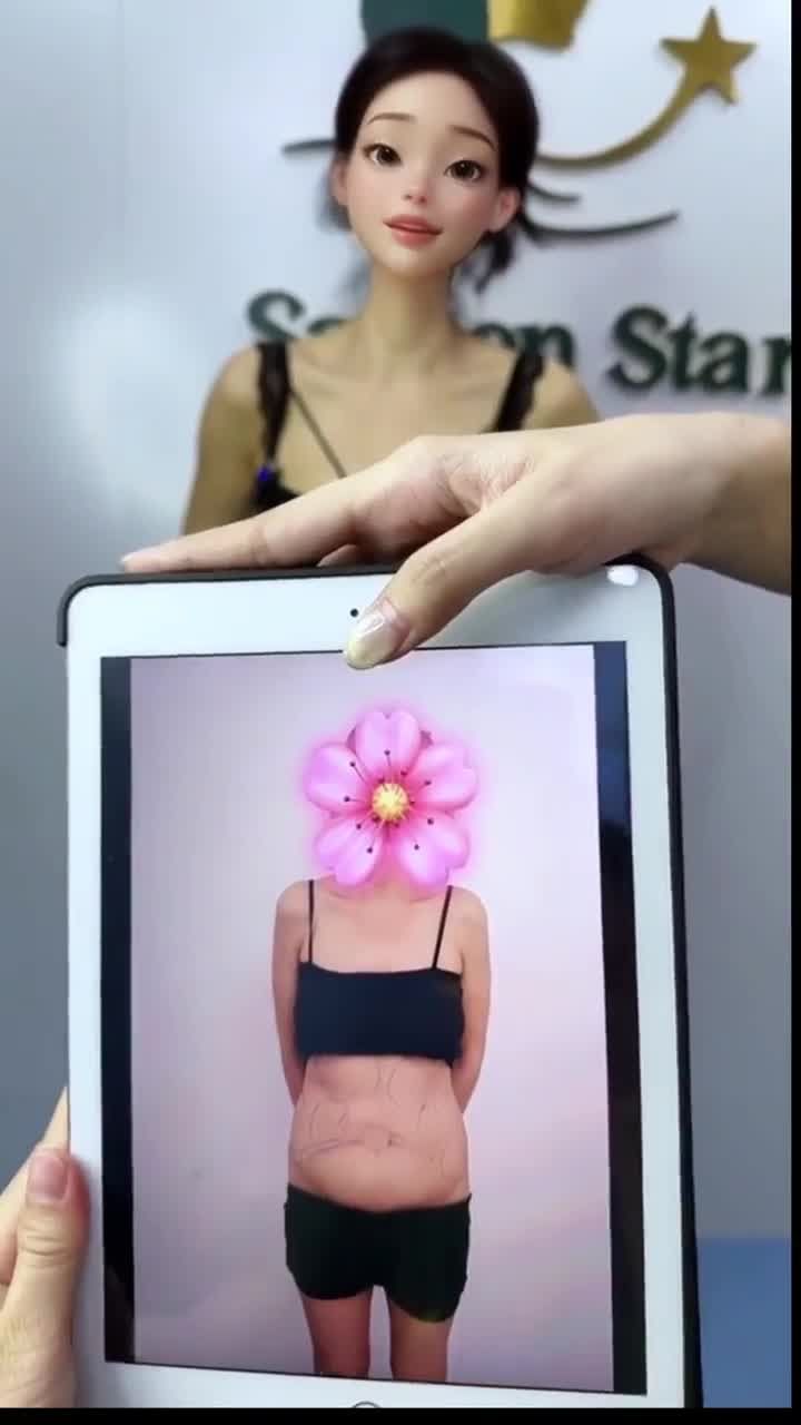 Review kết quả sau 14 ngày HÚT MỠ BỤNG 360° + CĂNG DA BỤNG