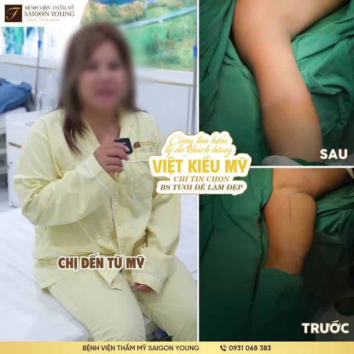 VIỆT KIỀU MỸ CHỈ TIN CHỌN BÁC SĨ TƯƠI THỰC HIỆN COMBO HẠ SIZE VÒNG 1 HỦY MỠ BẮP TAY TAY