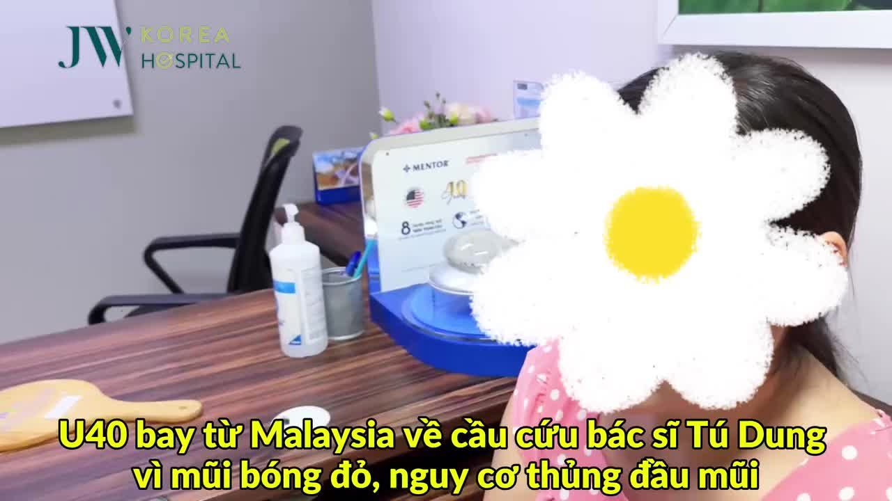 U40 HOẢNG LOẠN BAY TỪ MALAYSIA VỀ GẶP BÁC SĨ TÚ DUNG VÌ MŨI BÓNG ĐỎ, DA MŨI MỎNG SẮP THỦNG