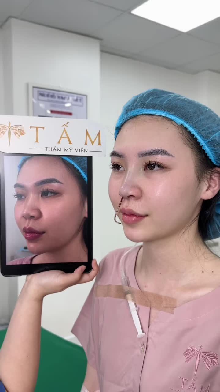 Bạn Nhung đến với TMV Tấm với mong muốn cải thiện sóng mũi tẹt, phần giữa bị gồ, đầu mũi to và hếch.